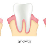 periodontal-care